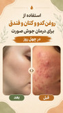 دوستان این نتیجه درمان واقعي سلامت جوی عزیزم هست مشکلات پوستی بخاطر مشکلات درونی مثل کبد گوارش استرس و اضطراب مشکلات خونی و قلبی هست پس از تشخیص و در پاکسازی درمان ریشهای اتفاق می افته هستم تا شما هم چنین پوست سالم و جوانی داشته باشین