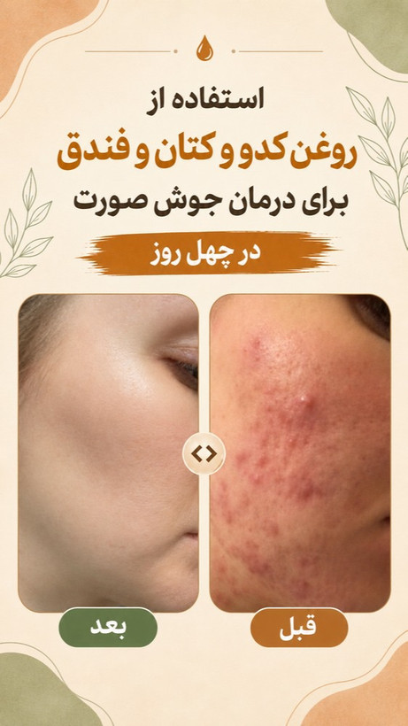 دوستان این نتیجه درمان واقعي سلامت جوی عزیزم هست مشکلات پوستی بخاطر مشکلات درونی مثل کبد گوارش استرس و اضطراب مشکلات خونی و قلبی هست پس از تشخیص و در پاکسازی درمان ریشهای اتفاق می افته هستم تا شما هم چنین پوست سالم و جوانی داشته باشین